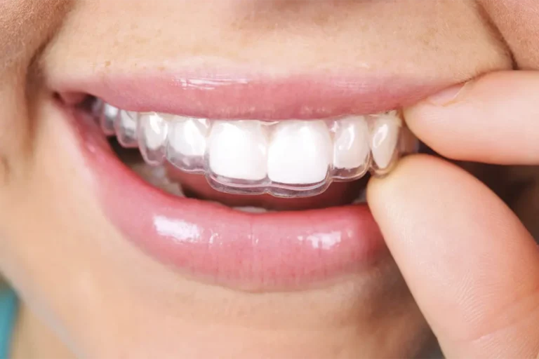 Woman Putting On Clear Aligners
