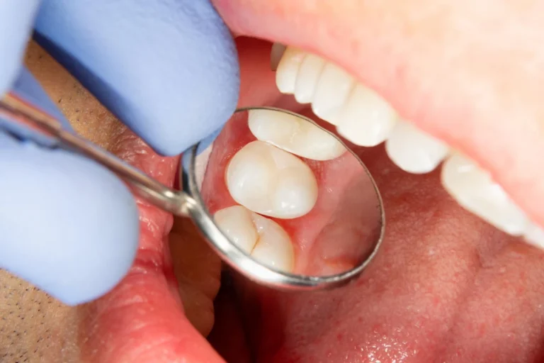 Dental Patient Receiving Dental Checkup for Cavities