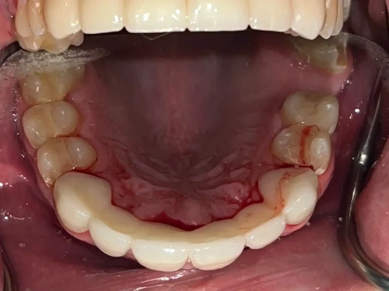 Dental Patient After Restorative Dental Care in Crown Point at Infuse Dental