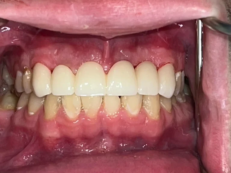 Dental Patient After Restorative Dental Care in Crown Point at Infuse Dental