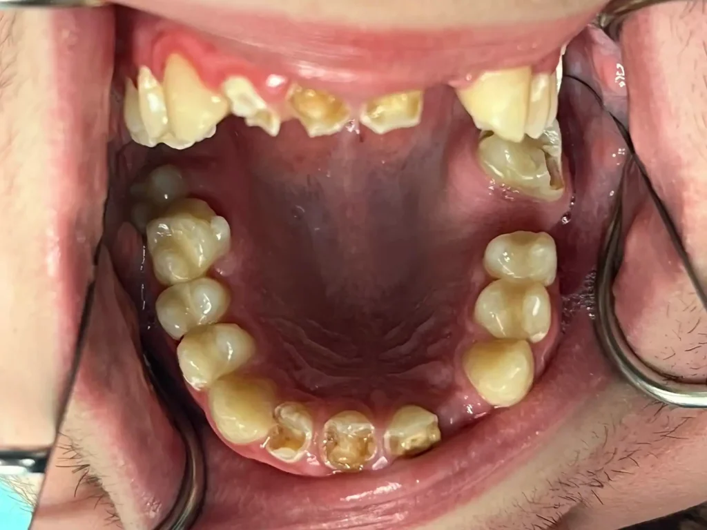 Dental Patient Before Restorative Dental Care in Crown Point at Infuse Dental
