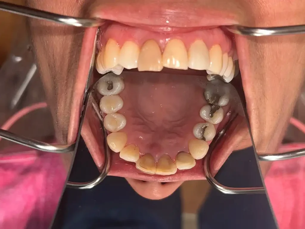 Dental Patient Teeth Before Restorative Dental Care in Crown Point Infuse Dental