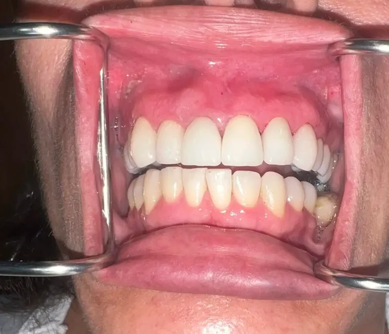 Patient Teeth After Dental Restorative Service in Crown Point at Infuse Dental