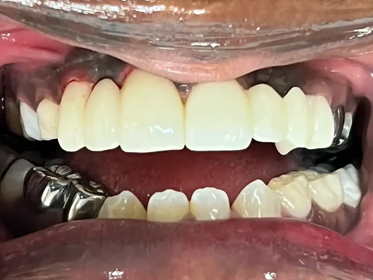 Patient Teeth After Dental Restorative Service in Crown Point at Infuse Dental