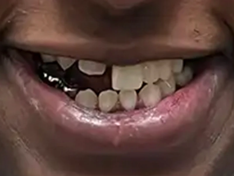 Patient Teeth Before Dental Restorative Service in Crown Point at Infuse Dental