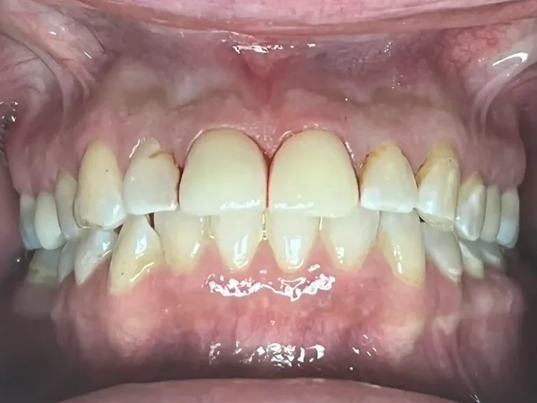 Patient Teeth After Dental Restorative Service in Crown Point at Infuse Dental