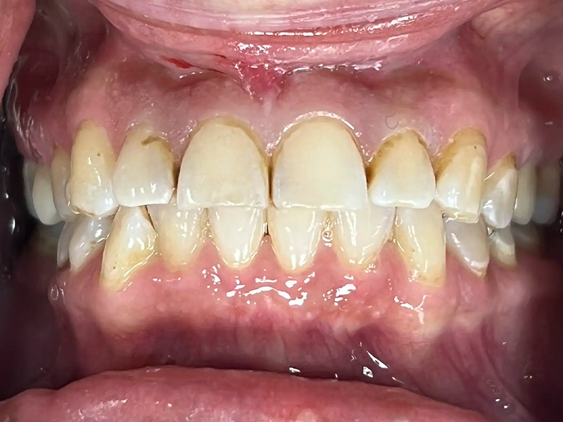 Patient Teeth Before Dental Restorative Service in Crown Point at Infuse Dental