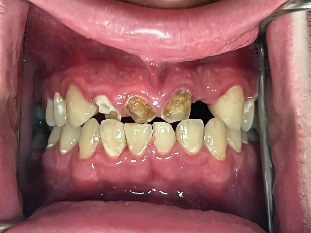 Dental Patient Before Restorative Dental Care in Crown Point at Infuse Dental