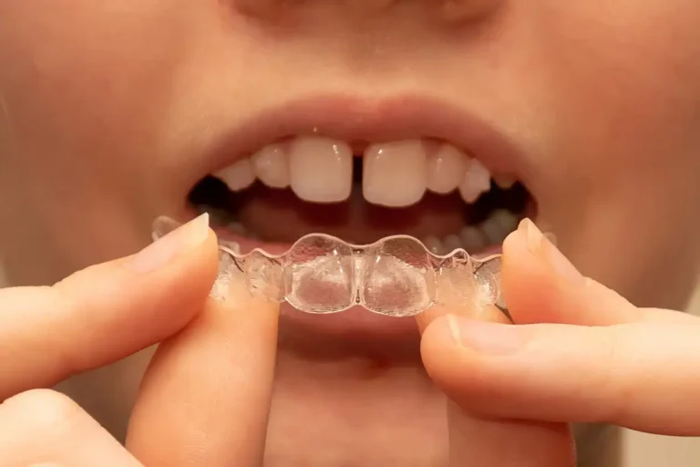 Dental Patient Using Invisalign® at Infuse Dental in Crown Point, IN